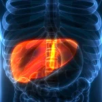 سرطان کبد